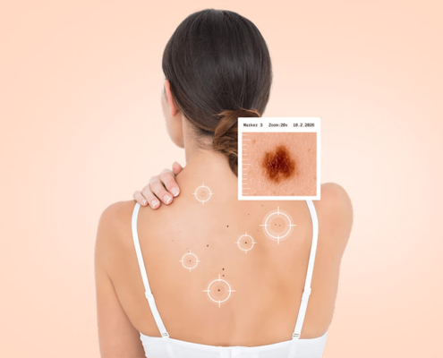Vyšetrenie znamienok: ako vyzerá moderná prevencia melanómu - Skyn Clinic